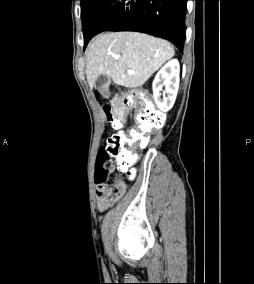Colon adenocarcinoma - hepatic flexure (Radiopaedia 85635-101395 D 18).jpg