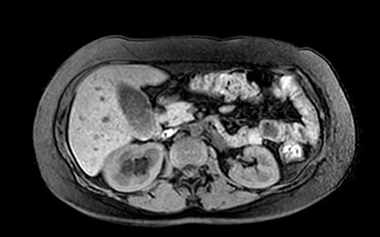 Colon adenocarcinoma with Krukenberg tumors, advanced pregnancy (Radiopaedia 67279-76645 A 55).jpg