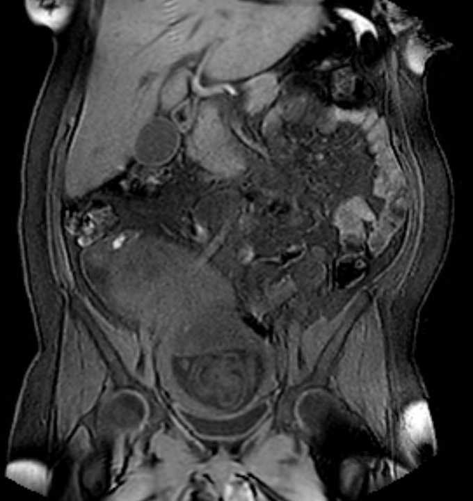 Colon adenocarcinoma with Krukenberg tumors, advanced pregnancy (Radiopaedia 67279-76645 E 41).jpg