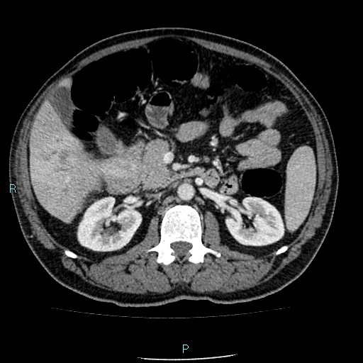 Colon adenocarcinoma with calcific liver metastasis (Radiopaedia 55745-62300 B 16).jpg