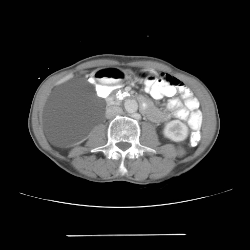 Colon cancer with calcified liver metastasis (Radiopaedia 74423-85307 A 36).jpg