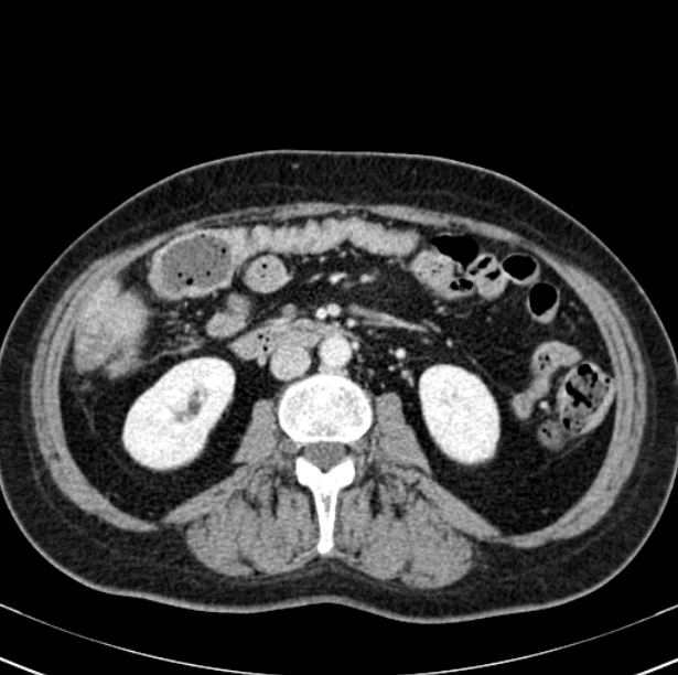 Colon carcinoma with hepatic metastases (Radiopaedia 29477-29961 A 55).jpg