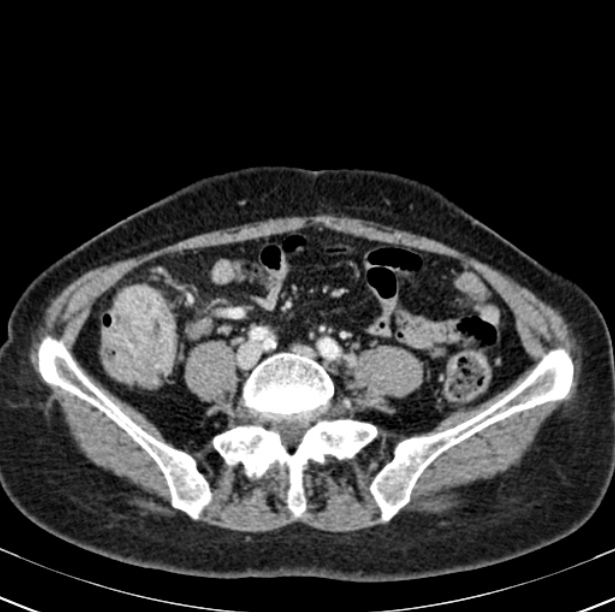 Colon carcinoma with hepatic metastases (Radiopaedia 29477-29961 A 76).jpg