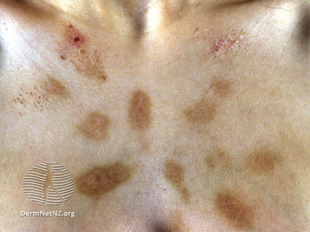 File:Dermatitis artefacta (DermNet NZ dermatitis-d-a).jpg