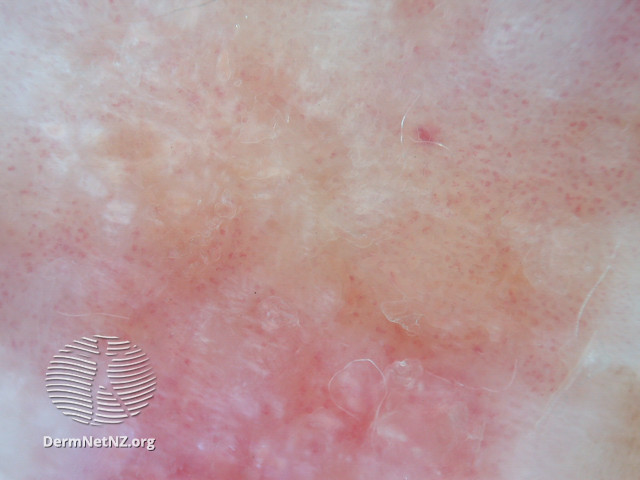 File:Dermoscopic view of squamous cell carcinoma (DermNet NZ 2-scc-dermosocpy).jpg