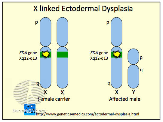 File:Ectodermal dysplasia (DermNet NZ Ectodermal-dysplasia).png