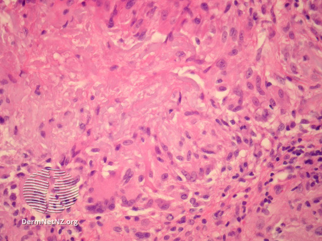File:Figure 2 (DermNet NZ pathology-e-actinic-granuloma-figure-2).jpg