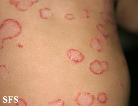 File:Impetigo (Dermatology Atlas 34).jpg