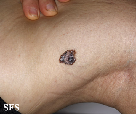 File:Melanoma (Dermatology Atlas 42).jpg