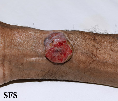 File:Melanoma (Dermatology Atlas 51).jpg