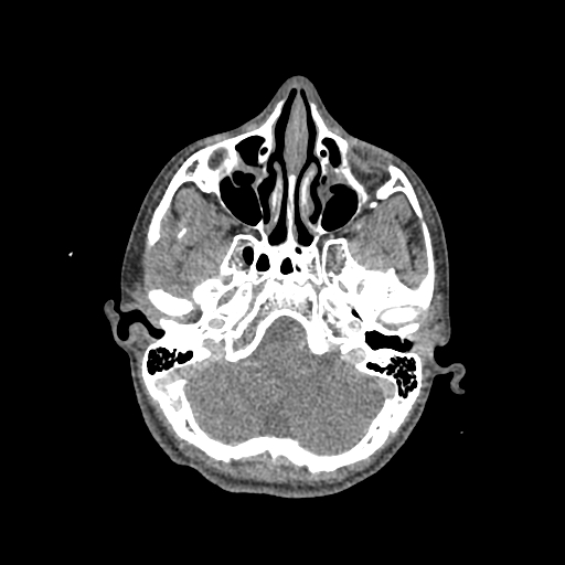 File:Nasal pyogenic granuloma (lobular capillary hemangioma) (Radiopaedia 85536-101244 C 81).jpg