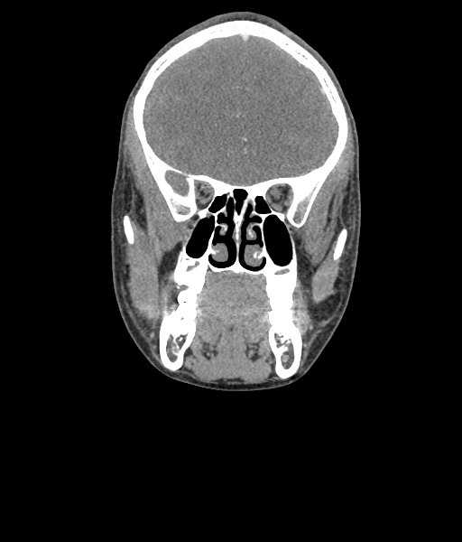 Nasal pyogenic granuloma (lobular capillary hemangioma) (Radiopaedia 85536-101244 D 55).jpg