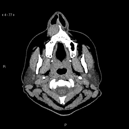 File:Nasolabial cyst (Radiopaedia 75125-86194 Axial non-contrast 39).jpg