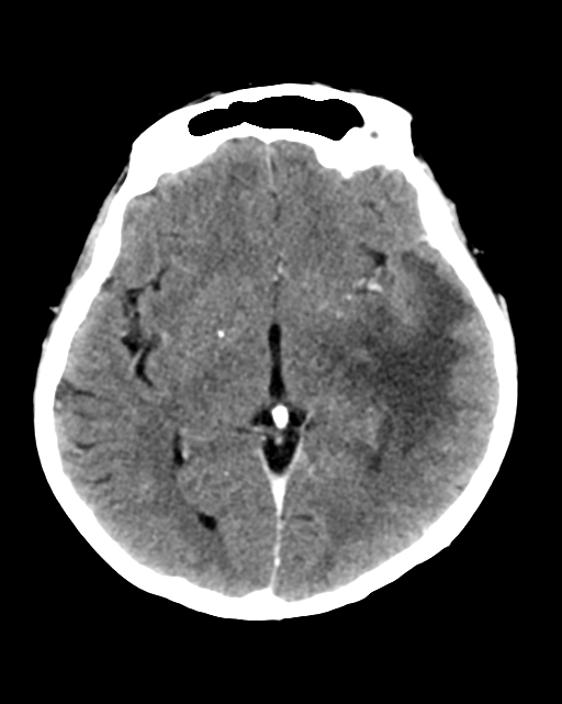 Nasopharyngeal carcinoma with cerebral abscess (Radiopaedia 43018-46275 Axial C+ delayed 25).png
