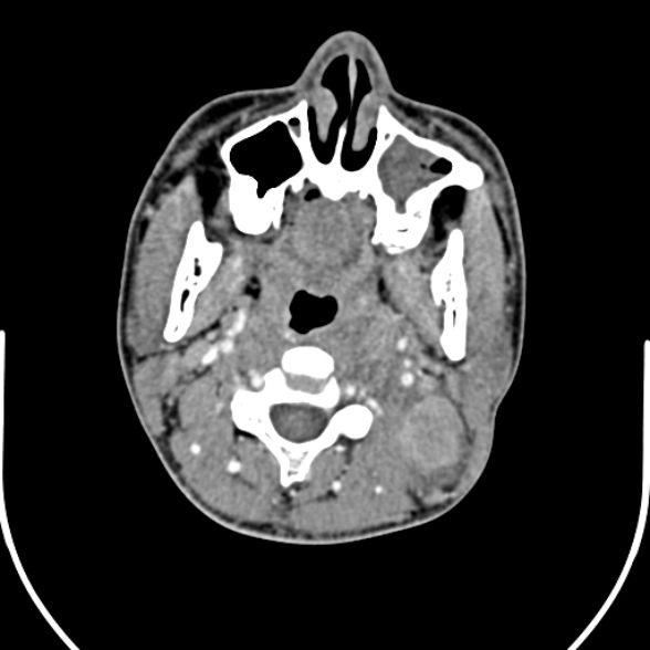 Nasopharyngeal carcinoma with skull base invasion (Radiopaedia 53415-59705 A 78).jpg