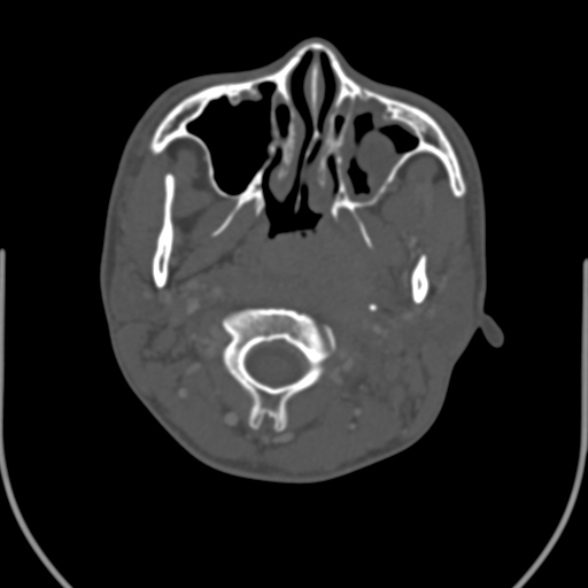 Nasopharyngeal carcinoma with skull base invasion (Radiopaedia 53415-59705 Axial bone window 58).jpg