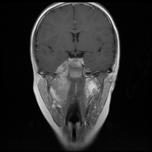 File:Nasopharyngeal rhabdomyosarcoma (Radiopaedia 23417-23486 Coronal T1 C+ 9).jpg