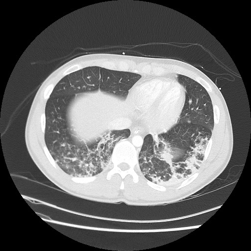 Near-drowning pulmonary edema (Radiopaedia 59457-66814 Axial lung window 45).jpg