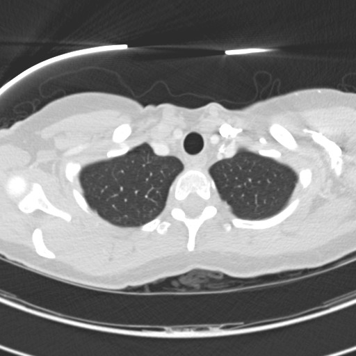 Necrobiotic pulmonary nodules - Crohn disease (Radiopaedia 20723-20631 Axial lung window 18).jpg