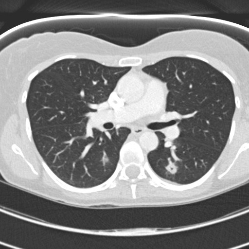 Necrobiotic pulmonary nodules - Crohn disease (Radiopaedia 20723-20631 Axial lung window 63).jpg