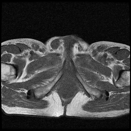File:Necrotizing epididymo-orchitis with intra-testicular abscess (Radiopaedia 29397-29860 Axial T1 8).jpg