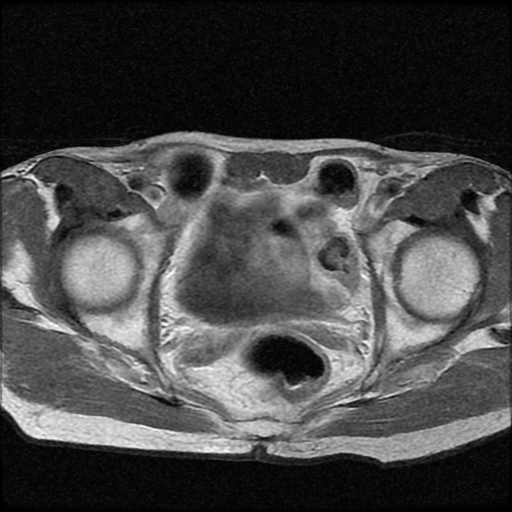 File:Necrotizing epididymo-orchitis with intra-testicular abscess (Radiopaedia 29397-29860 Axial T1 C+ 1).jpg