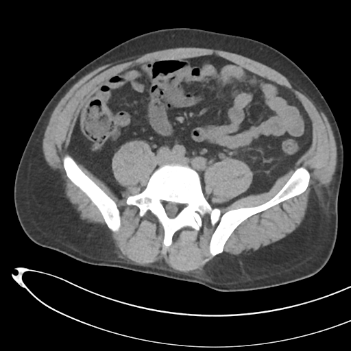 File:Necrotizing pancreatitis with acute necrotic collections (Radiopaedia 38829-41012 Axial non-contrast 55).png
