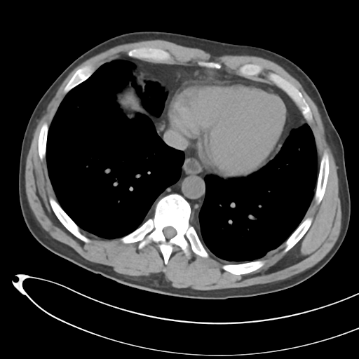 File:Necrotizing pancreatitis with acute necrotic collections (Radiopaedia 38829-41012 Axial non-contrast 6).png