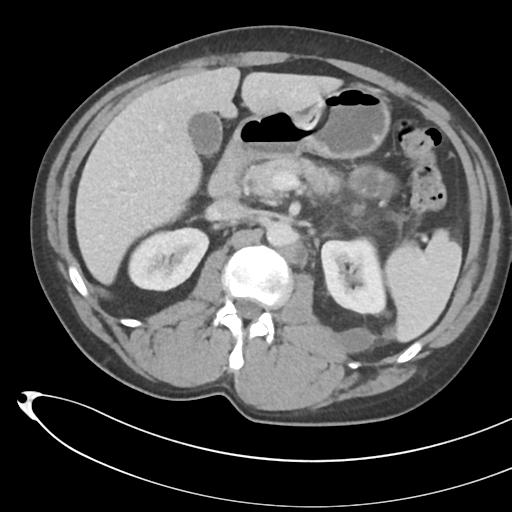 File:Necrotizing pancreatitis with acute necrotic collections (Radiopaedia 38829-41012 B 31).png