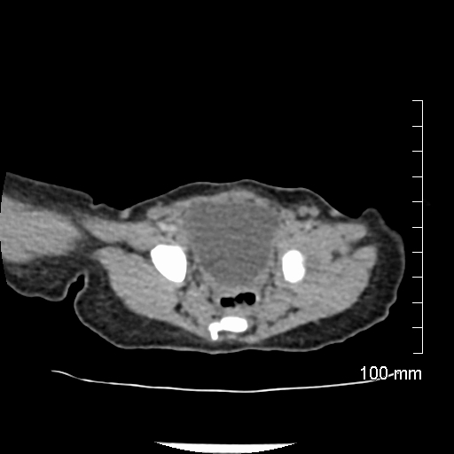 File:Neonatal neuroblastoma (Radiopaedia 56651-63438 Axial non-contrast 72).jpg