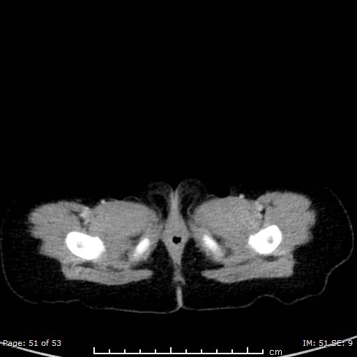 Nephroblastomatosis (Radiopaedia 41934-44935 A 51).jpg