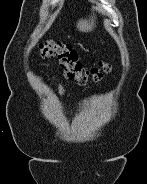 File:Nephrostomy for urosepsis (Radiopaedia 26180-26330 non-contrast 15).jpg