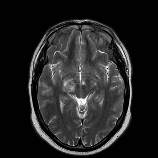 File:Neuro-Behcet's disease (Radiopaedia 21557-21505 Axial T2 10).jpg
