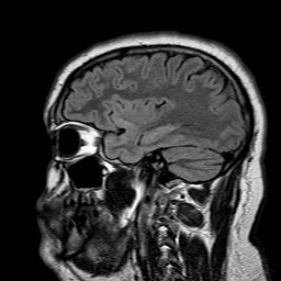 File:Neuro-Behcet's disease (Radiopaedia 21557-21506 Sagittal FLAIR 26).jpg
