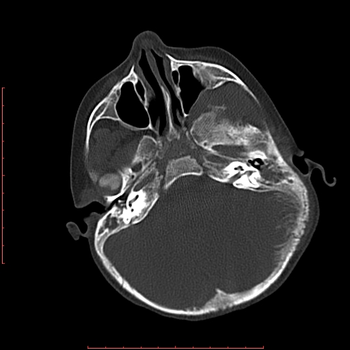 File:Neuroblastoma skull metastasis (Radiopaedia 56053-62683 Axial bone window 7).jpg