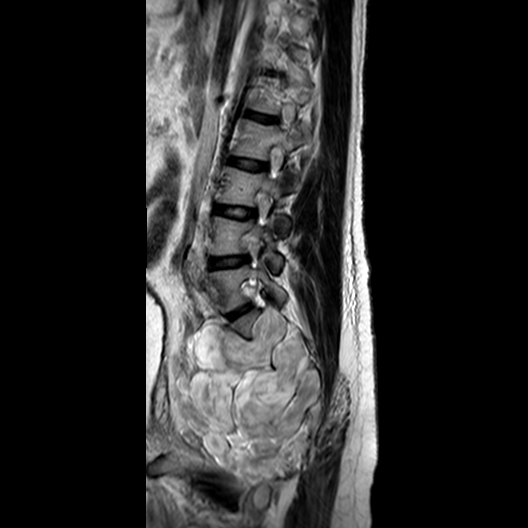 File:Neurofibromatosis type 1- extensive spinal involvement and Christmas tree sign (Radiopaedia 60610-68332 Sagittal T2 10).jpg