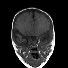 File:Neurofibromatosis type 1 (Radiopaedia 30089-30671 Coronal T1 9).jpg