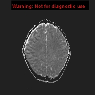 File:Neurofibromatosis type 1 with optic nerve glioma (Radiopaedia 16288-15965 Axial ADC 7).jpg