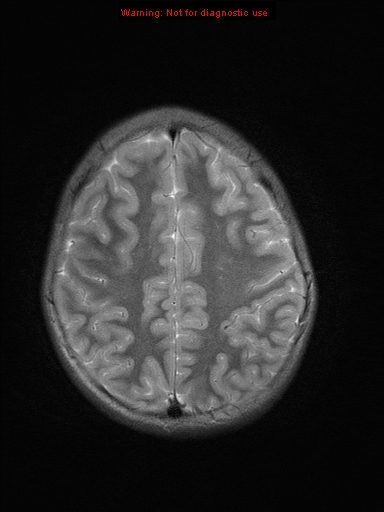 File:Neurofibromatosis type 1 with optic nerve glioma (Radiopaedia 16288-15965 Axial T2 7).jpg