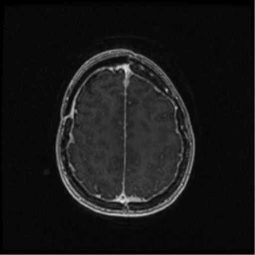 Neurofibromatosis type 2 (Radiopaedia 45229-49244 Axial T1 C+ 91).png