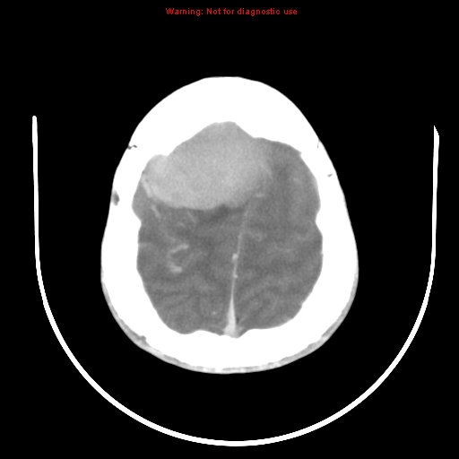 File:Neurofibromatosis type 2 (Radiopaedia 8953-9732 C 27).jpg