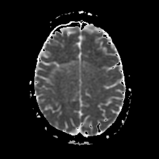 File:Neurofibromatosis type 2 - bilateral acoustic neuromata (Radiopaedia 40060-42566 Axial ADC 15).png