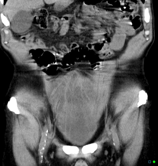 File:Neurogenic bladder - CT findings (Christmas tree bladder) (Radiopaedia 26995-27174 Coronal non-contrast 1).jpg