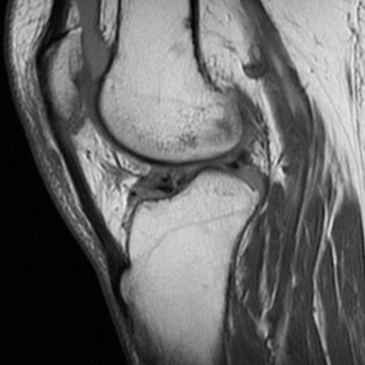 File:Non-displaced patella fracture (Radiopaedia 15932-15582 Sagittal T1 12).jpg