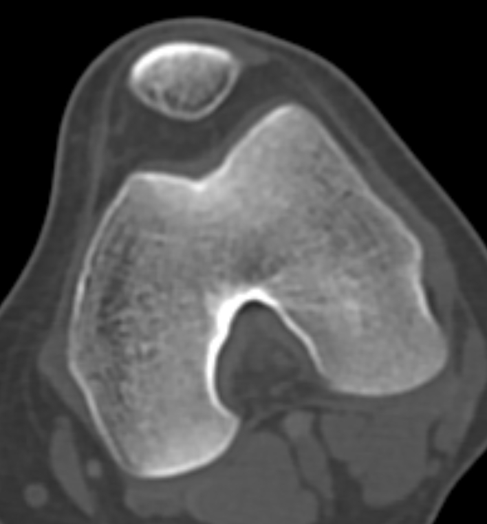 Non-ossifying fibroma - femur (Radiopaedia 82786-97042 Axial bone window 55).jpg
