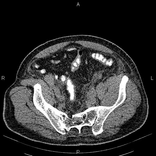 File:Non Hodgkin lymphoma in a patient with ankylosing spondylitis (Radiopaedia 84323-99621 Axial non-contrast 52).jpg