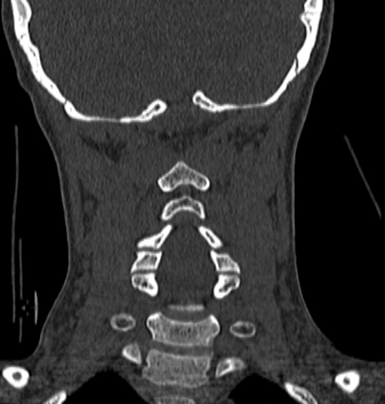 File:Normal CT cervical spine - 12-year-old (Radiopaedia 55352-61775 Coronal bone window 143).jpg