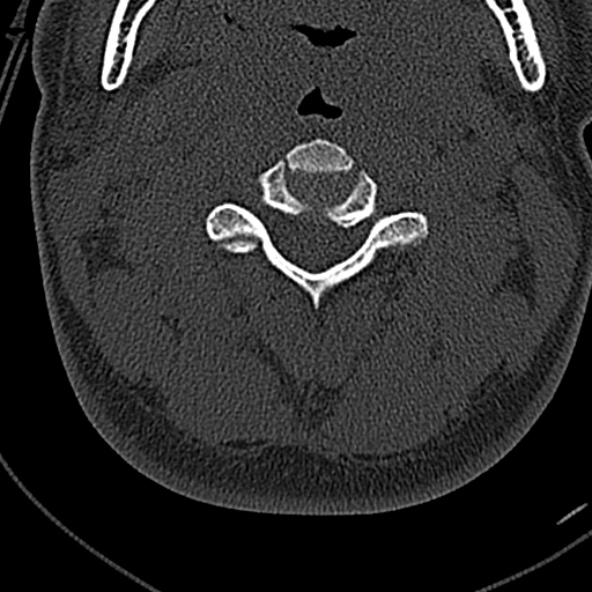 Normal CT of the cervical spine (Radiopaedia 53322-59305 Axial bone window 100).jpg