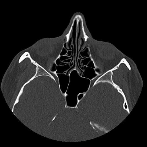Normal CT paranasal sinuses (Radiopaedia 42286-45390 Axial bone window 54).jpg