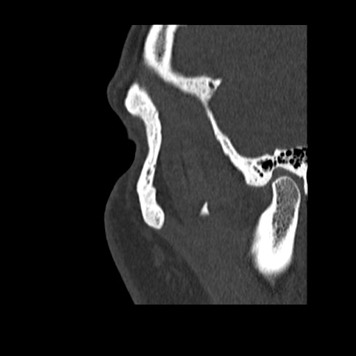 Normal CT paranasal sinuses (Radiopaedia 42286-45390 Sagittal bone window 99).jpg